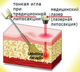 Лазерная липосакция